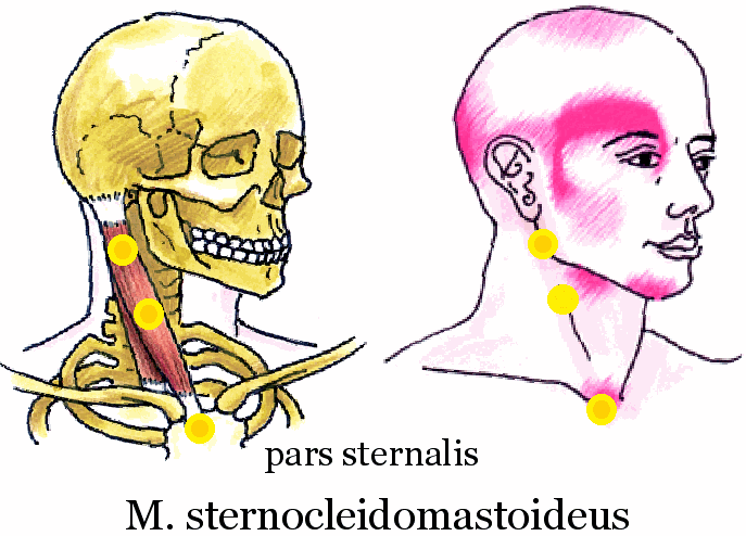 Sternocleidomastoideus-pars